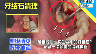 【下饭伴侣】触目惊心,花生大小的牙结石?记录一次酸爽的洗牙体验... ...